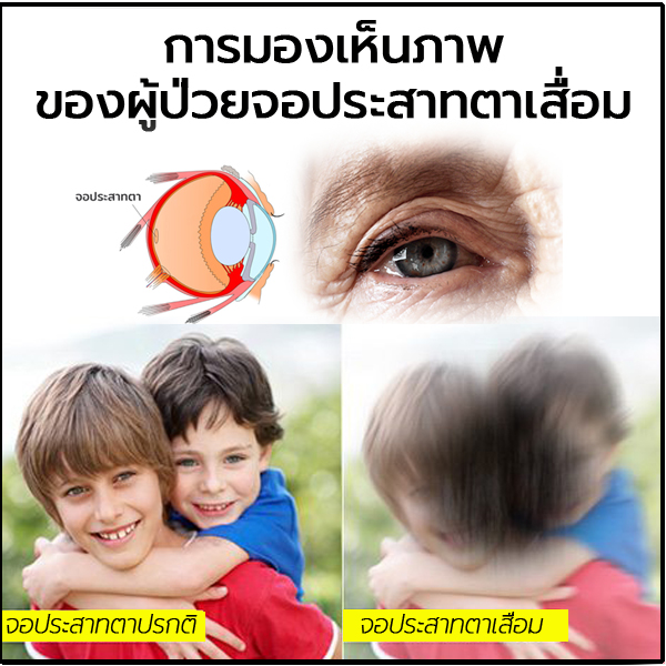 จอประสาทตาเสื่อม - ดีคอนแทค ดูแลดวงตา by ณิชา : Inspired by ...