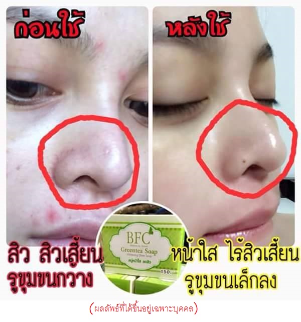 สบู่ชาเขียว หน้าใส ลดสิว BFC Greentea Soap