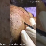 หน้าพัง ติดสาร สิวอุดตัน ไม่หายสักที ดูคลิปนี้...จะพบทางออกที่ดี